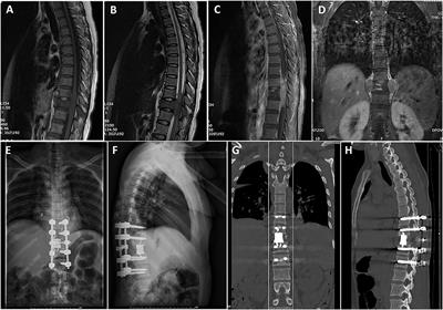 Treatment Outcomes and Prognostic Factors of Patients With Primary Spinal Ewing Sarcoma/Peripheral Primitive Neuroectodermal Tumors